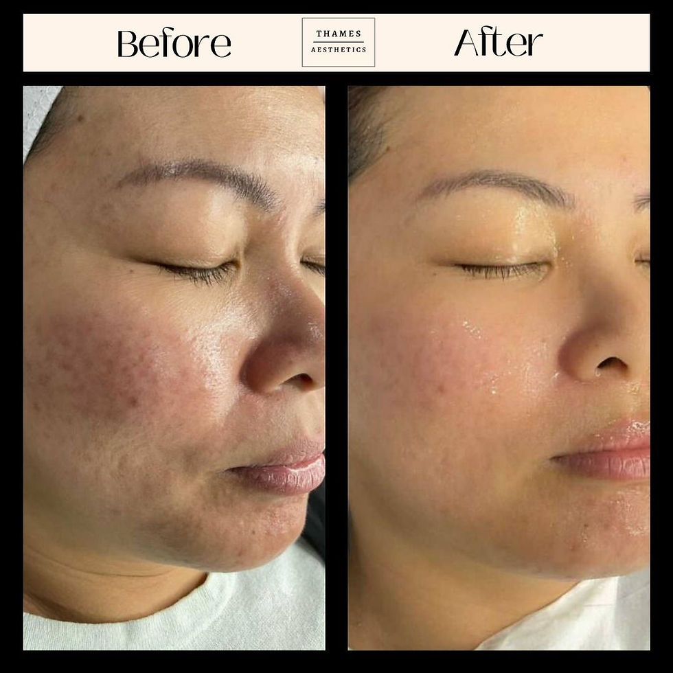 Microneedling enhances skin texture and promotes a smoother, more radiant complexion_