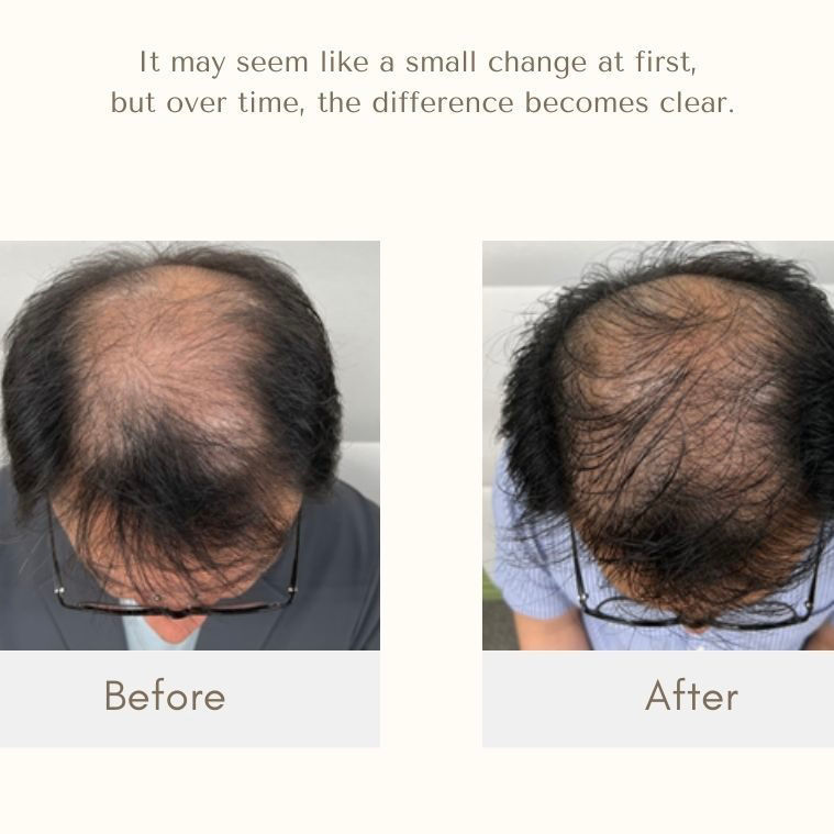 縮圖：STEMIR 22 Hair Booster  專業級毛囊生髮精華