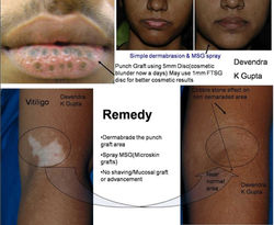 Vitiligo Management
