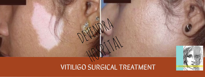 Vitiligo (safed daag/ white spots/ leukoderma) is NOT a stigma anymore!!!