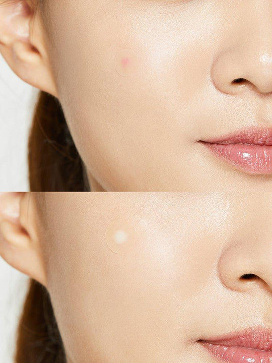 Thumbnail: COSRX Acne Pimple Master Patch (24 patches)