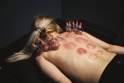 Cupping Thrapy at Troy City Cryolounge