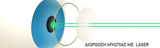 MYOPIA  LASER CORRECTION