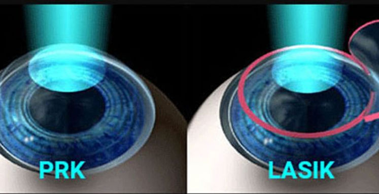 prk-lasik-800x324.jpeg