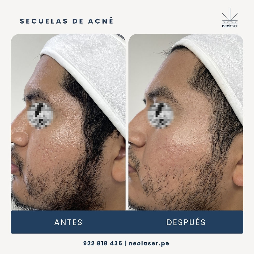 Cicatrices de acné: ¿Qué tipo tienes y cómo tratarlas?