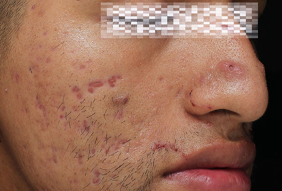 Antes y después secuelas/ marcas del acné