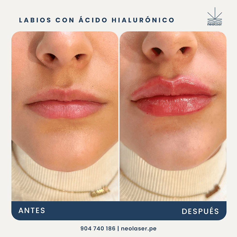 Volumen de labios con Ácido Hialurónico
