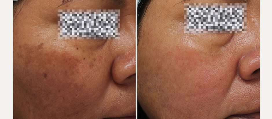 Manchas solares vs. melasma: aprende a diferenciarlas