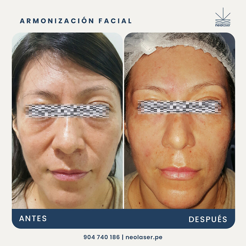 Paciente de Armonización facial con Ácido Hialurónico