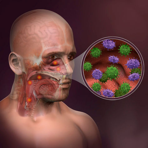 Infecciones del tracto respiratorio superior
