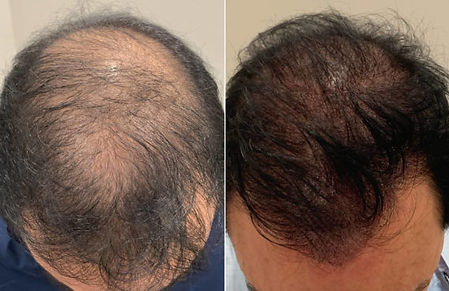 patient-108036-scalp-micropigmentation-before-after-570x369.jpg