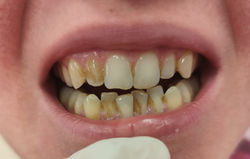stav zubů před dentální hygienou