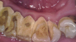 ZUBNÍ KÁMEN DENTÁLNÍ HYGIENA