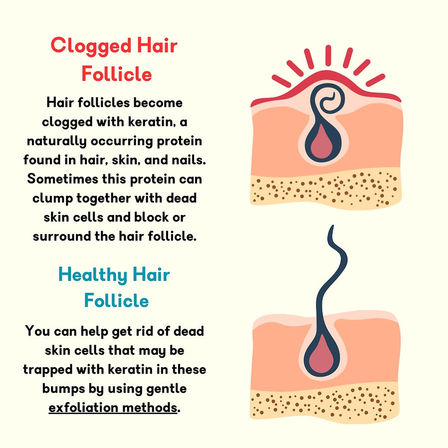 strawberry legs and clogged hair follicle