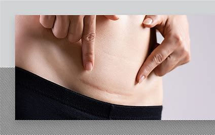 a woman pointing to a scar from a c-section
