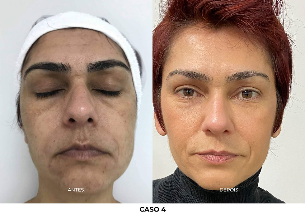 mulher apontando ponteira do ultrassom para o rosto e sorrindo
