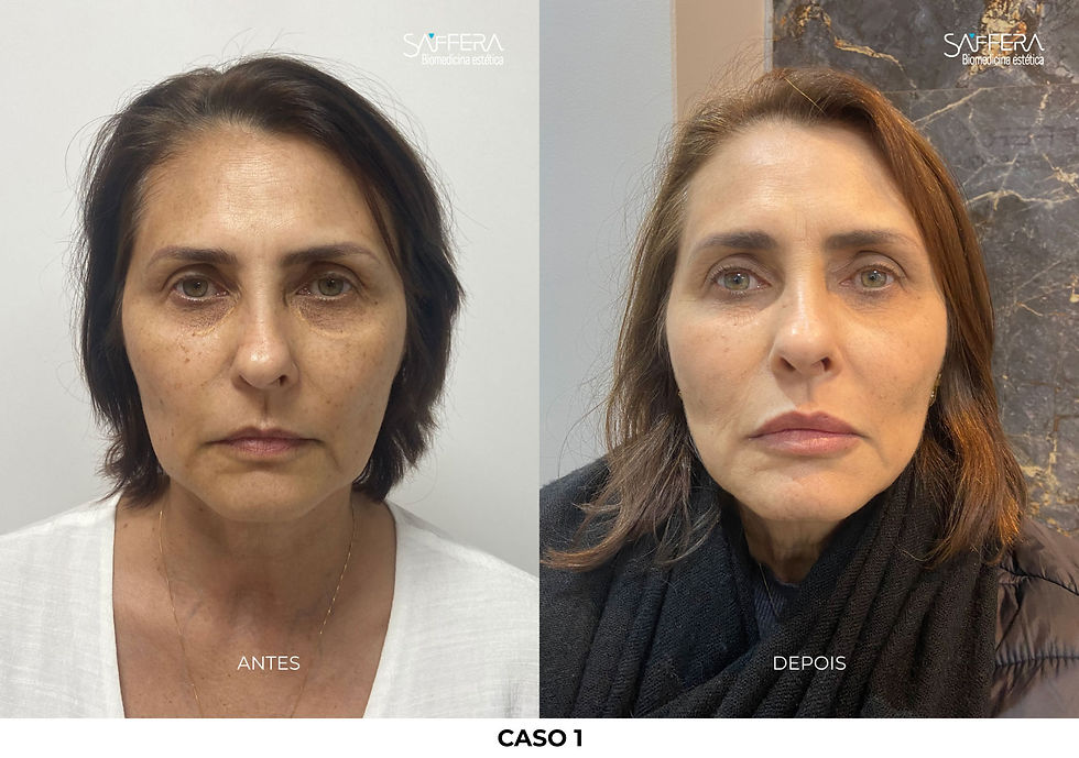 mulher apontando ponteira do ultrassom para o rosto e sorrindo