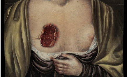 wounds brystkreft.PNG