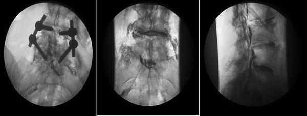 neuroplastía peridual lumbar