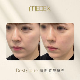 Medex restyalne