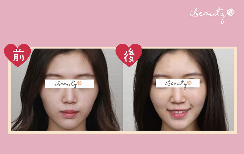 Thumbnail: 【Sculptra®童顏針療程(全面)】