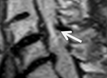 Estenose do canal vertebral