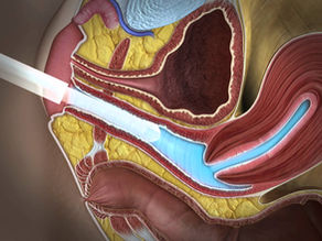 Ultrassom Endovaginal com gel