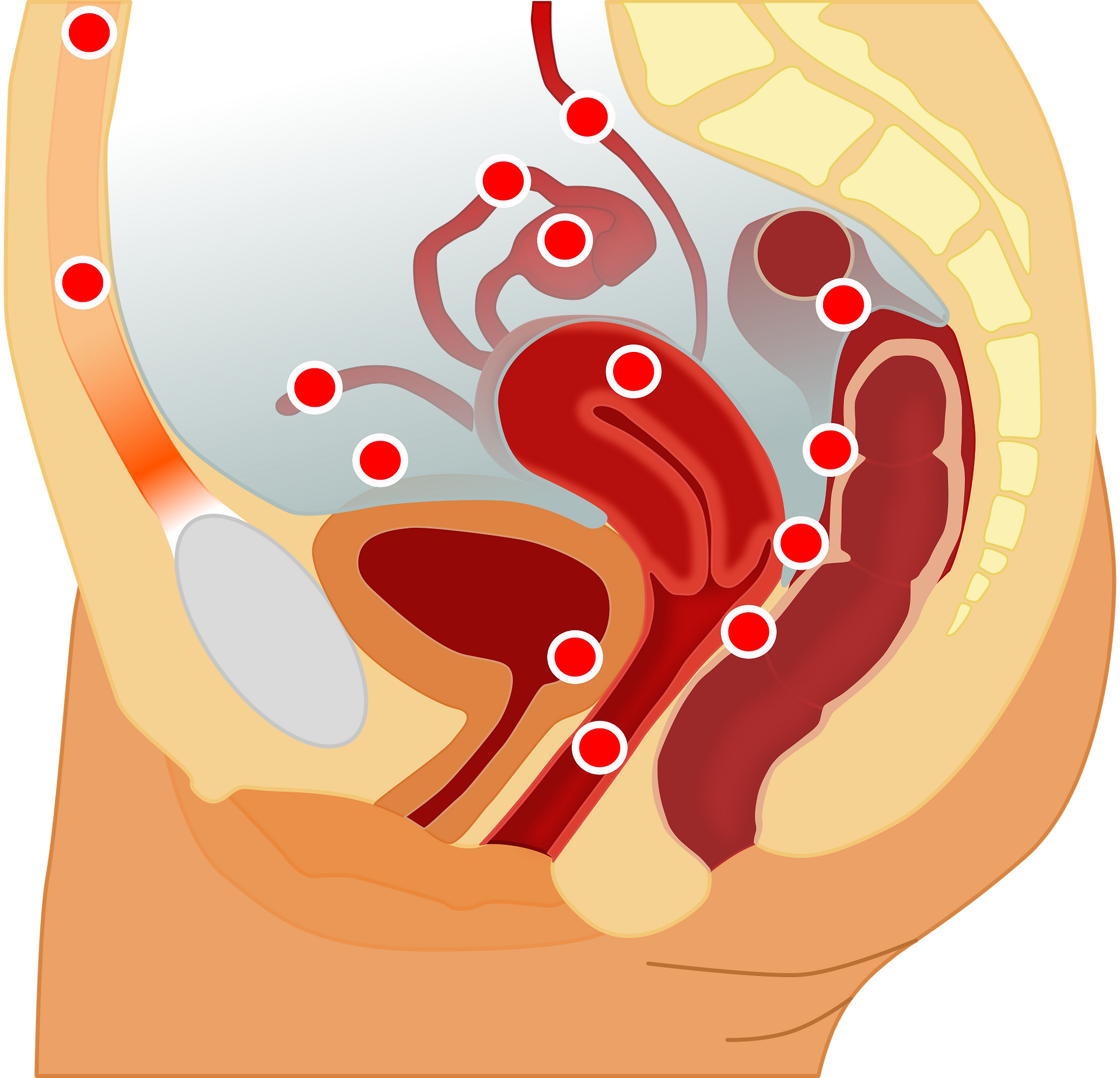 focos endometriose na pelve vista lateral