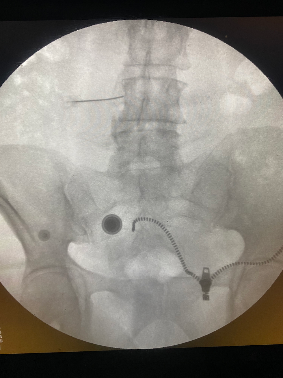 Una inyección espinal guiada por fluoroscopia es un procedimiento mínimamente invasivo en el que, usando imágenes en tiempo real, se administra medicación en la columna para aliviar el dolor.