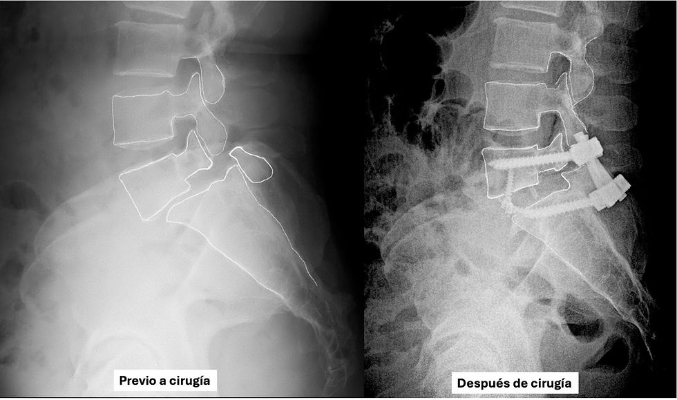 Radiografías de columna antes y después de cirugía. A la derecha, implantes visibles. Texto: "Previo a cirugía" y "Después de cirugía".