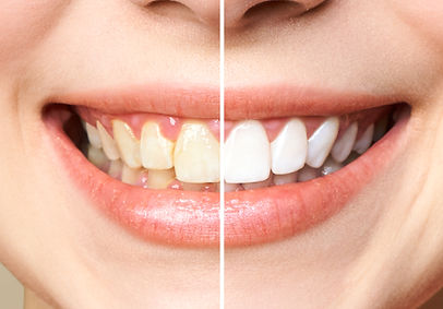 teeth whitening.jpg
