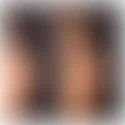 Before and after nose correction showing what is rhinoplasty and its facial balance results