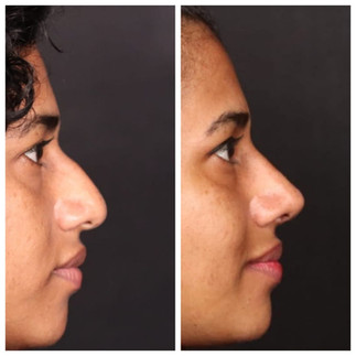 Before and after nose correction showing what is rhinoplasty and its facial balance results