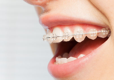 clear braces.jpg
