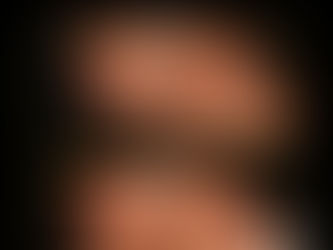 chin implant images