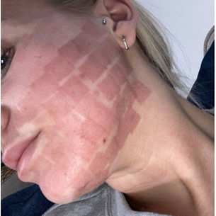 CO₂ laser resurfacing.