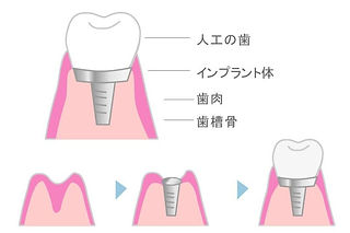 インプラント