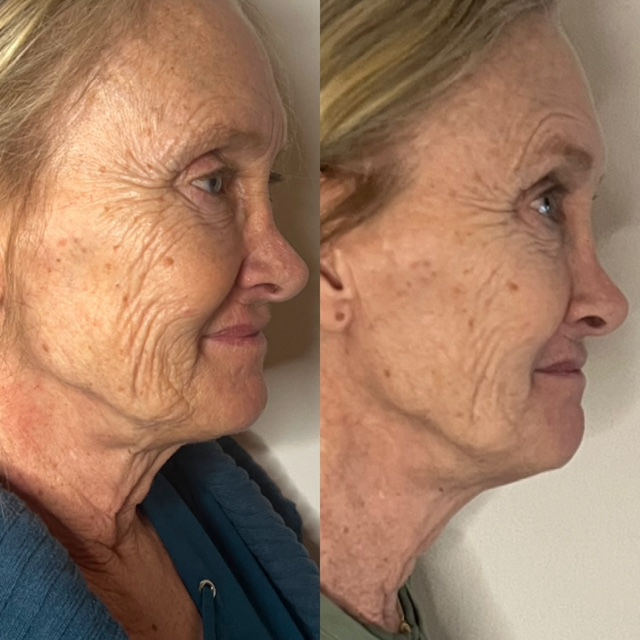 Check out Terry's results after ONE 5D Hifu facelift