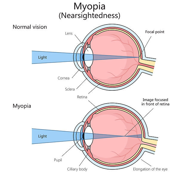 myopia diagram