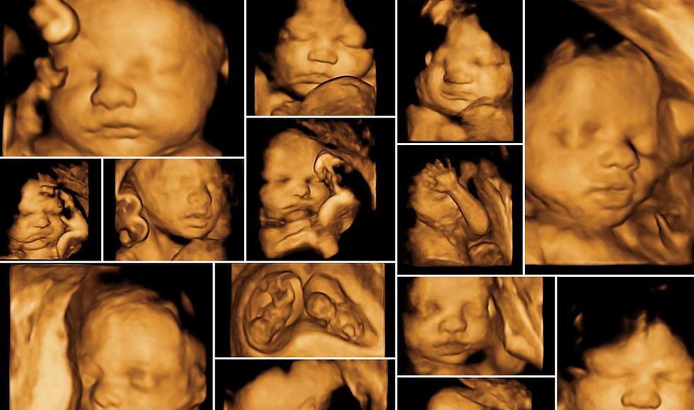Ultrasound-3D-4D