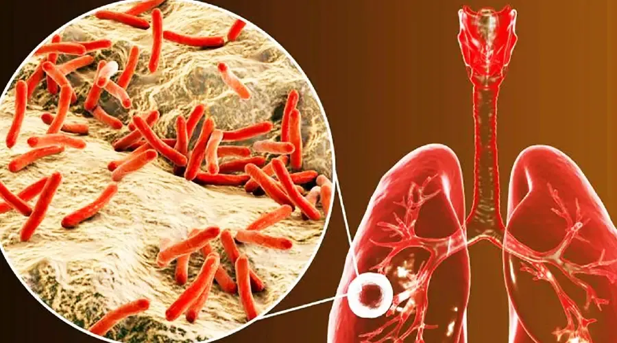 Refuerzan lucha contra la tuberculosis en La Romana con jornada de capacitación médica