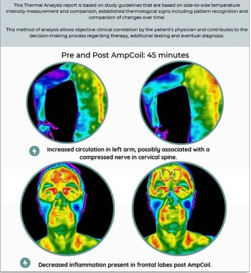 Thermal analysis report pre and post AmpCoil on human body