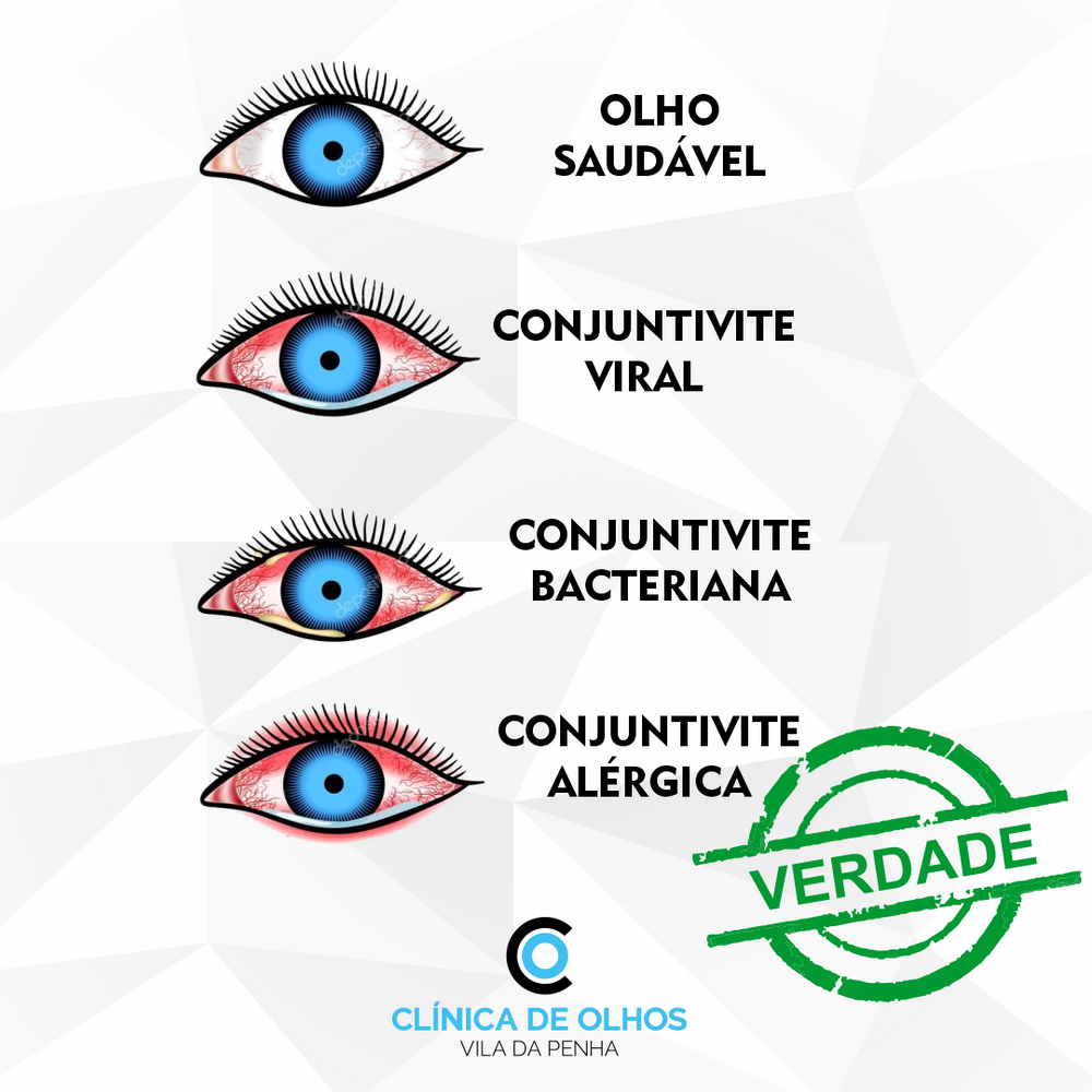 CONJUNTIVITE