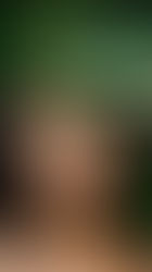 7 Ways To Get Rid Of Acne Scars