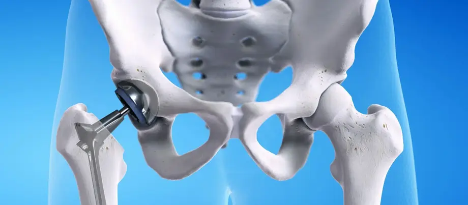 Hip Replacement