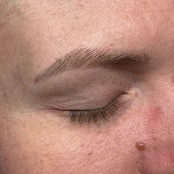 before laser pmu brow removal