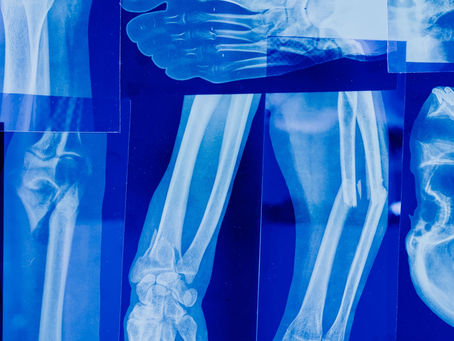 Understanding Osteogenesis Imperfecta (OI)