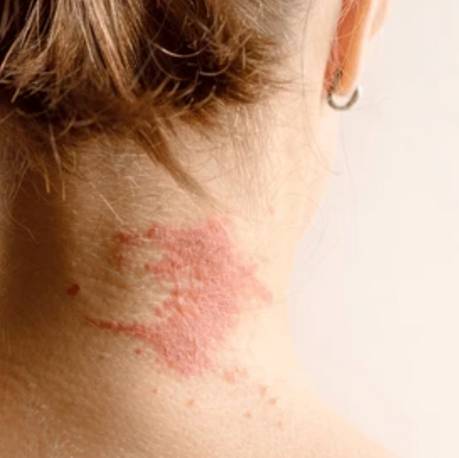 Neurodermitis Behandlung mit Akupunktur und CELLSTARK