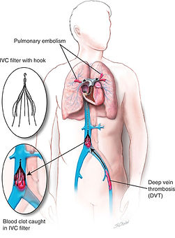 ivc-filter.jpeg