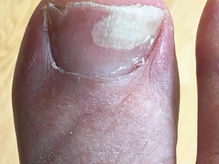 A big toe showing onycholysis of the nail